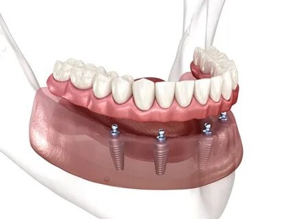 Idaho Falls dentures and implants