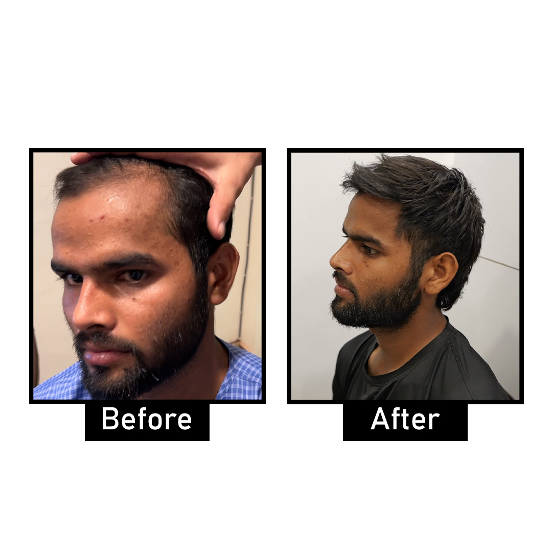 Hair Transplant in Delhi NCR