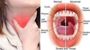 A close-up image of an inflamed throat showing red and swollen tonsils with white patches, indicating tonsillitis.